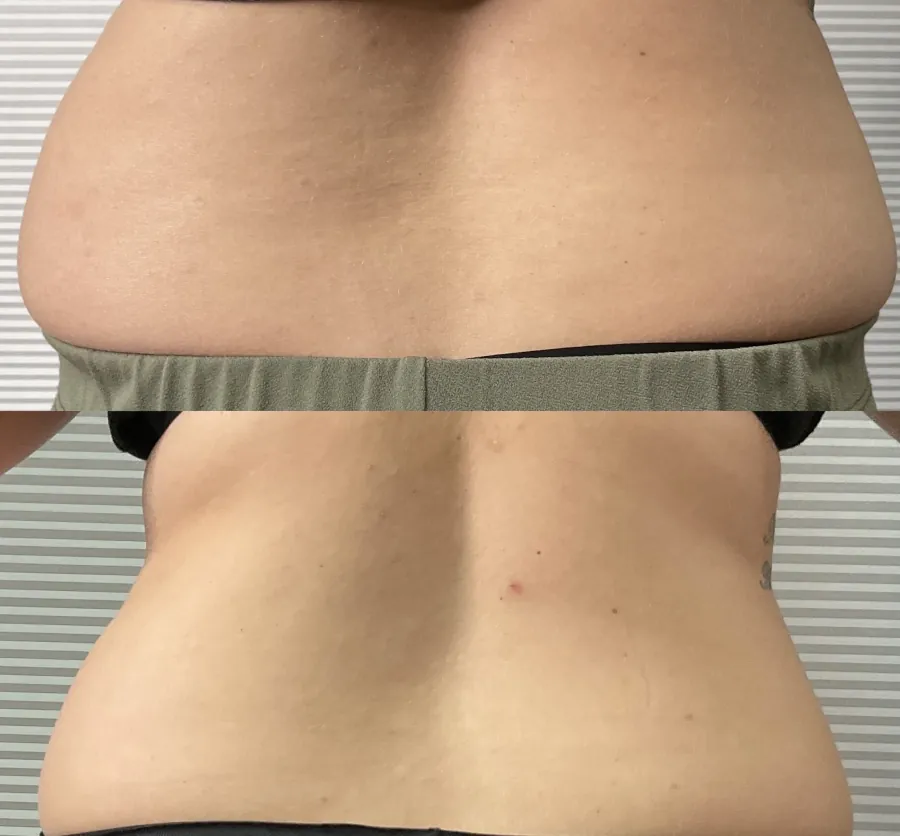 waist reduction from injections